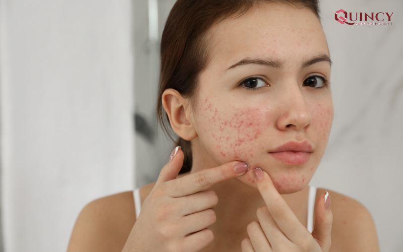 Bỏ túi 5 cách làm mặt nạ trị mụn tại nhà đơn giản, hiệu quả nhất 17 Những thói quen nhỏ góp phần hình thành mụn