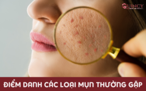 Điểm Danh Các Loại Mụn Thường Gặp
