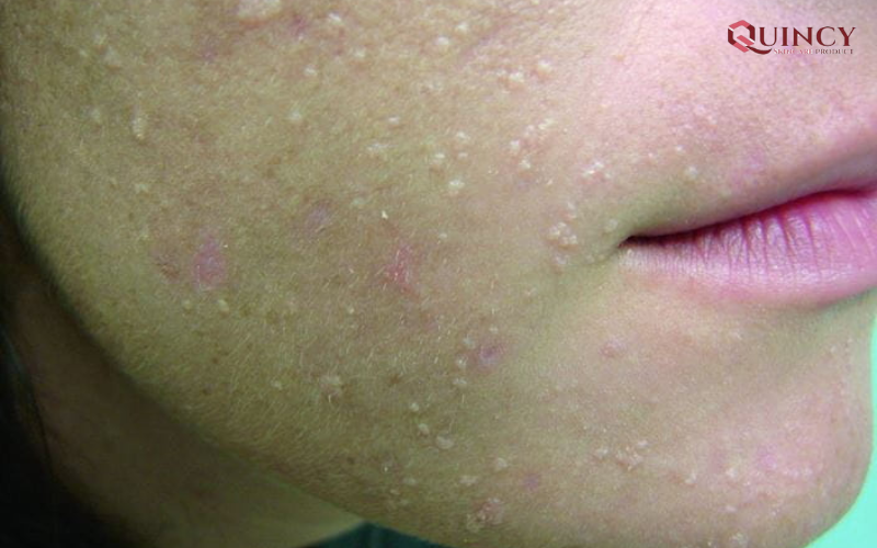 Mụn cóc phẳng là gì? Biện pháp điều trị mụn cóc phẳng tận gốc 12 Những yếu tố gây nên mụn cóc phẳng