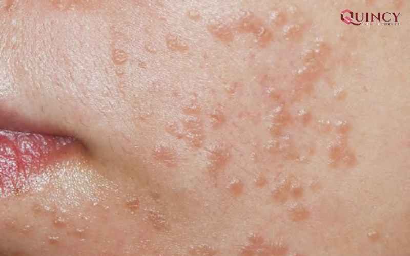 Mụn cóc phẳng là gì? Biện pháp điều trị mụn cóc phẳng tận gốc 11 Mụn cóc phẳng là gì?