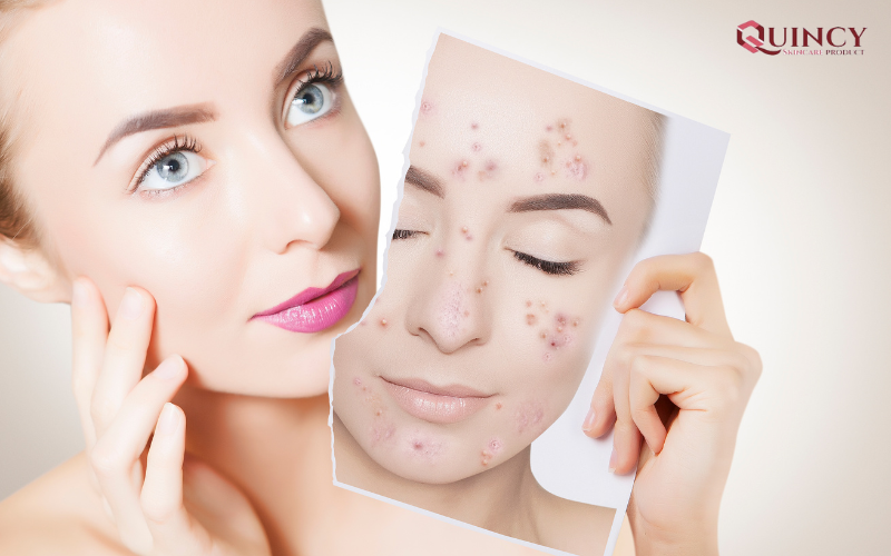 Mụn cóc phẳng là gì? Biện pháp điều trị mụn cóc phẳng tận gốc 14 Mụn cóc phẳng có tự hết hay không?