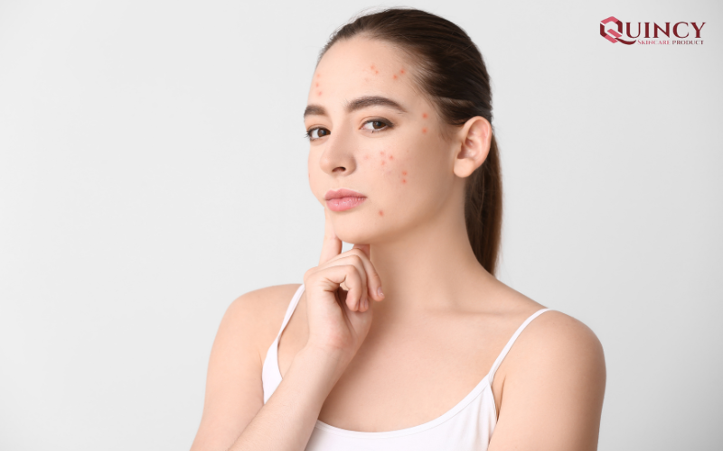Mụn nội tiết ở nữ giới là gì? Biện pháp trị mụn nội tiết hiệu quả nhất hiện nay 13 Mụn nội tiết ở nữ giới trong độ tuổi dậy thì