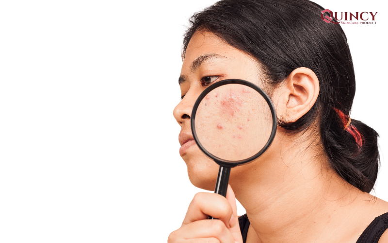 Mụn nội tiết ở nữ giới là gì? Biện pháp trị mụn nội tiết hiệu quả nhất hiện nay 12 Tại sao thay đổi nội tiết lại gây ra mụn?