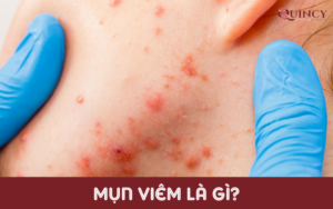 Mụn Viêm Là Gì?