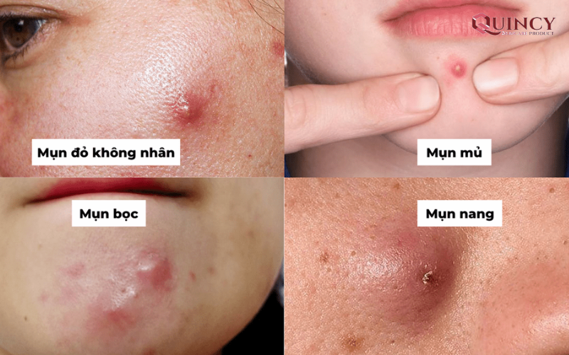 Mụn viêm là gì? Điều trị mụn viêm như thế nào cho hiệu quả? 12 Phân loại mụn viêm