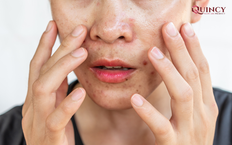 Quy trình chăm sóc da dầu mụn buổi tối đúng chuẩn cho làn da sáng mịn 10 Tính chất của da dầu mụn