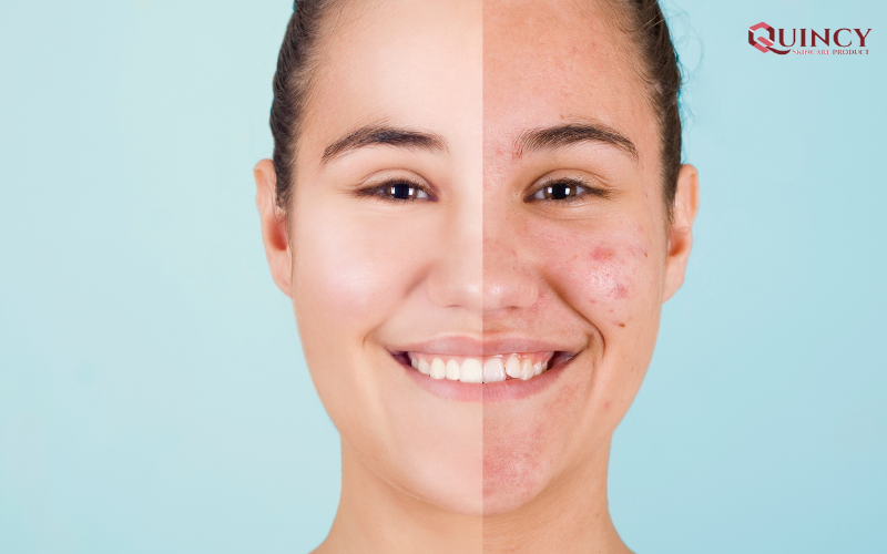 Serum giảm mụn an toàn lành tính cho mọi làn da 12 Phân biệt các loại mụn như thế nào?