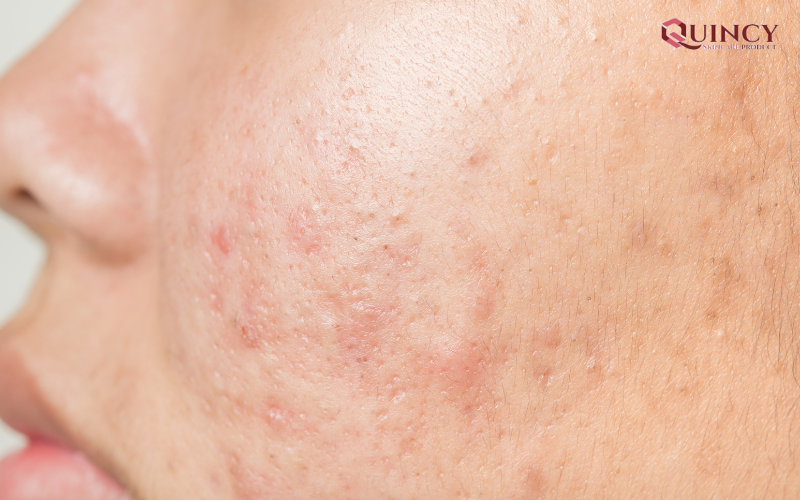 Serum giảm mụn an toàn lành tính cho mọi làn da 13 Mụn thường xuất hiện ở đâu?