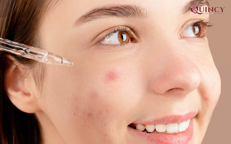 Serum giảm mụn an toàn lành tính cho mọi làn da 16 Sử dụng serum giảm mụn có hiệu quả không?