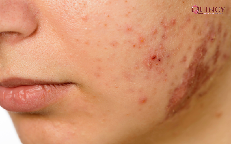 Serum giảm mụn an toàn lành tính cho mọi làn da 14 Nguyên nhân gây ra mụn là gì?