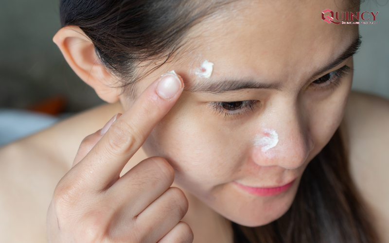 Cần lưu ý gì khi thoa kem trị mụn?