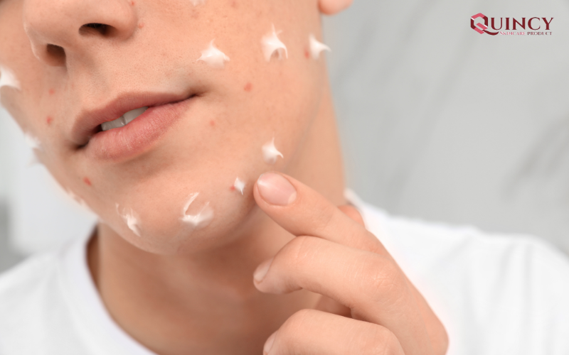 Nên thoa kem trị mụn trước hay sau serum để có kết quả tốt nhất?