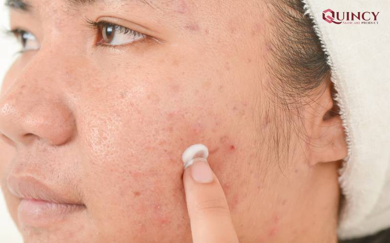 Tại sao cần dùng kem trị mụn?