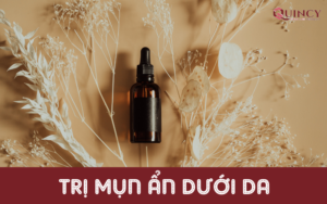 trị mụn ẩn dưới da