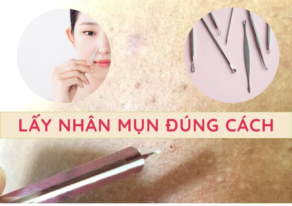 Hướng dẫn lấy nhân mụn tại nhà không để lại thâm sẹo 14 Huong dan lay nhan mun tai nha khong de lai tham seo