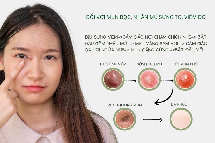 Hướng dẫn lấy nhân mụn tại nhà không để lại thâm sẹo 17 Serum tri mun Doctor care 20