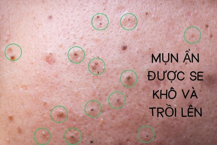 Hướng dẫn lấy nhân mụn tại nhà không để lại thâm sẹo 15 Serum tri mun Doctor care 21