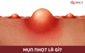 Mụn nhọt là gì?