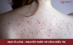 Mụn ở lưng - Nguyên nhân và cách điều trị