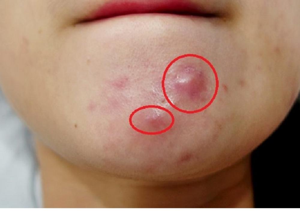 Hướng dẫn lấy nhân mụn tại nhà không để lại thâm sẹo 16 muon het mun phai lam sao 19