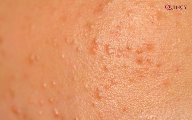 Serum trị mụn Đồng Tháp hiệu quả, giá rẻ, tốt nhất 11 Nguyên nhân gây ra mụn