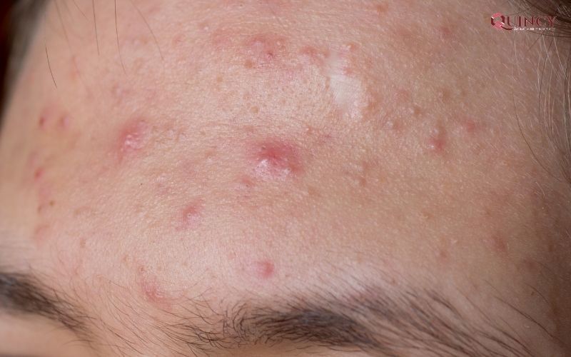Serum trị mụn Đồng Tháp hiệu quả, giá rẻ, tốt nhất 10 Tình trạng mụn