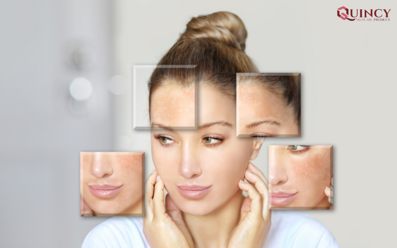 Sản phẩm Serum trị mụn Hà Giang hiệu quả, trị mụn tận gốc 15 Xác định tình trạng da của bản thân