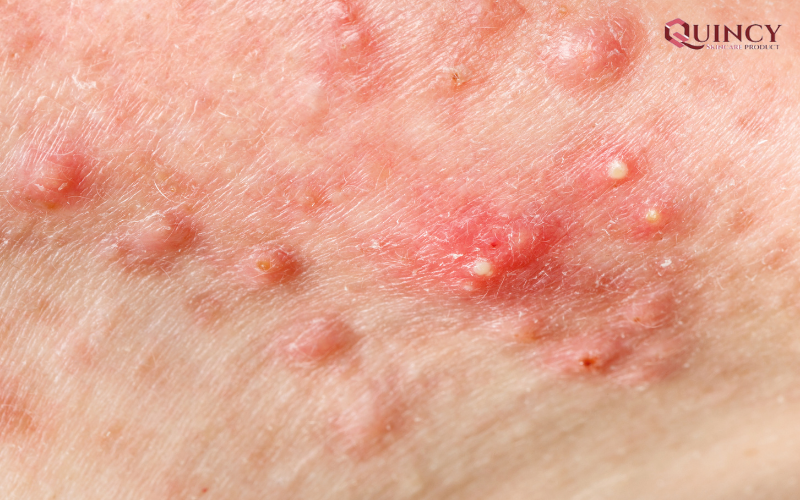 Serum trị mụn Hà Nam phù hợp với mọi loại da, hiệu quả trị mụn tốt 10 Mụn - Nguyên nhân sinh mụn