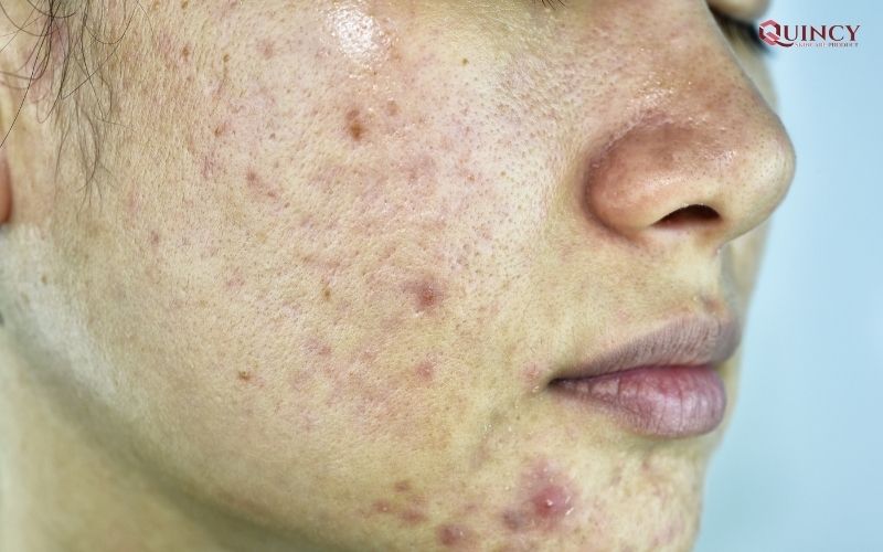 Serum trị mụn Hòa Bình giá rẻ, hiệu quả nhất 11 Những tác hại của mụn