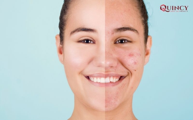 Top Serum trị mụn Lạng Sơn chất lượng, hiệu quả, lành tính 12 Hạn chế mọc mụn bằng những thói quen nhỏ
