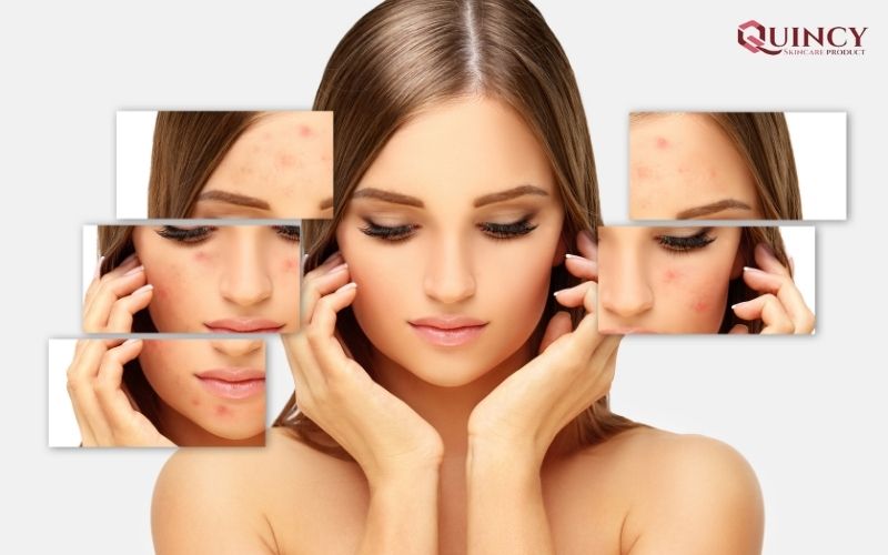 Loại Serum trị mụn Phú Thọ hiệu quả, chất lượng, giá rẻ 11 Mụn là gì? Nguyên nhân gây mụn?