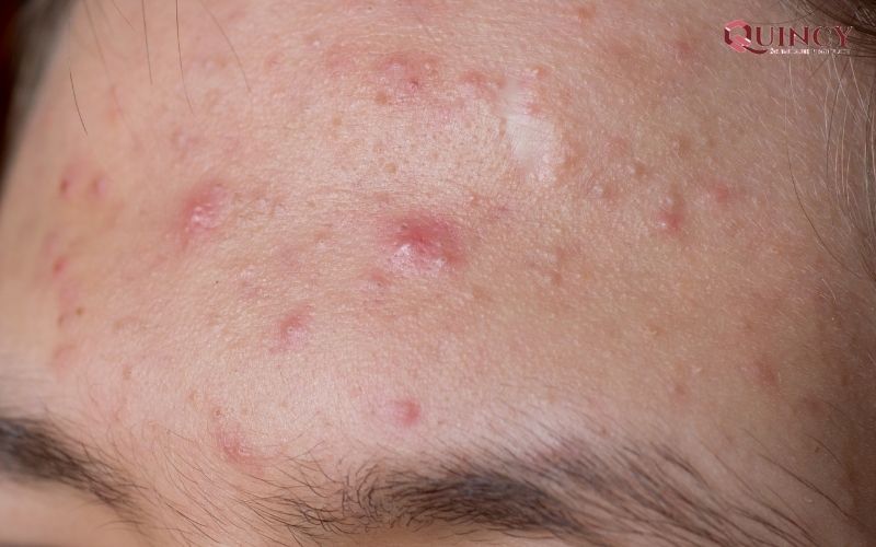 Trị mụn tại nhà hiệu quả với Serum trị mụn Phú Yên 11 Mụn là gì?