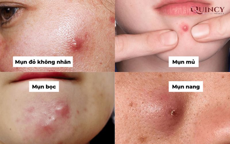 Serum trị mụn Quảng Nam làm trắng da, se khít lỗ chân lông 12 Phân biệt các loại mụn như thế nào?