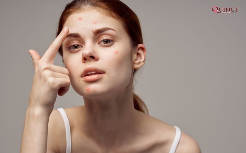 Serum trị mụn Quảng Nam làm trắng da, se khít lỗ chân lông 13 Mụn thường xuất hiện ở đâu?