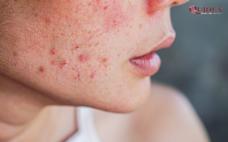 Serum trị mụn Quảng Nam làm trắng da, se khít lỗ chân lông 11 Mụn là gì?
