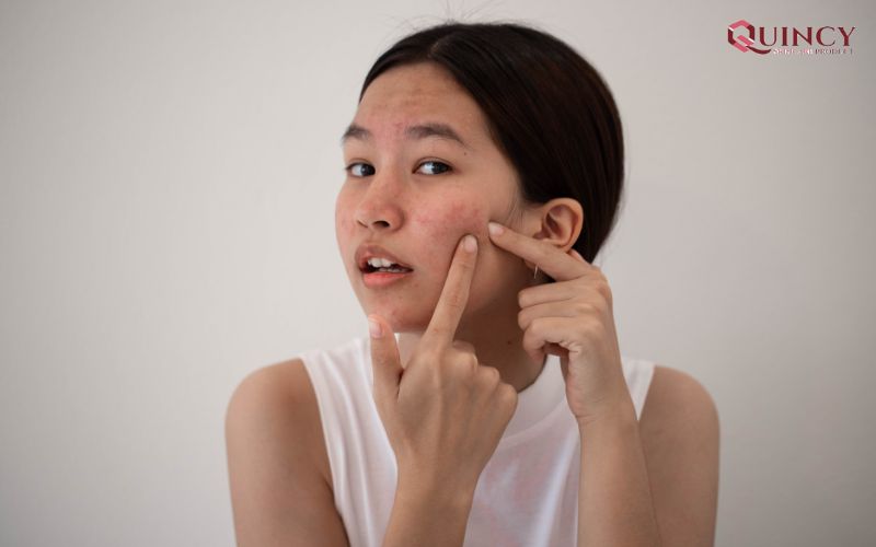 Những loại Serum trị mụn Quảng Trị tốt nhất, hiệu quả cao 12 Những thói quen tiêu cực góp phần hình thành mụn
