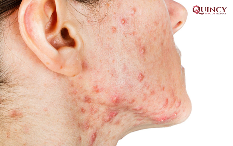 Serum trị mụn TPHCM hiệu quả, giá rẻ, an toàn 43 Mụn là gì?