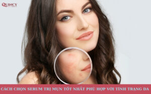 Cách chọn serum trị mụn tốt nhất phù hợp với tình trạng da