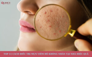 Cách trị mụn viêm đỏ không nhân tại nhà