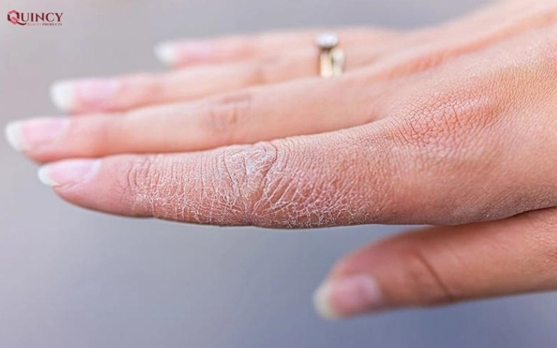 Cách trị khô da tay chân vào mùa đông