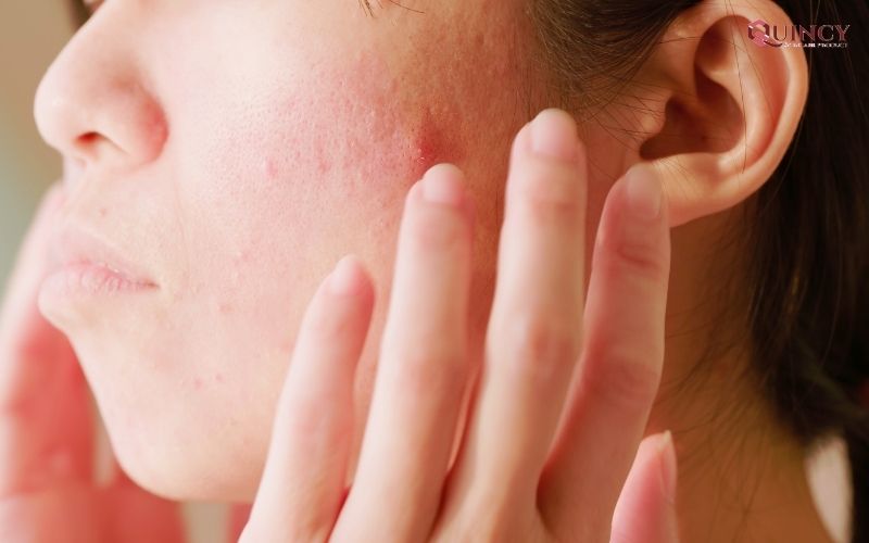 Da mặt bị ngứa thì phải làm sao? 12 Tại sao da mặt bị ngứa?