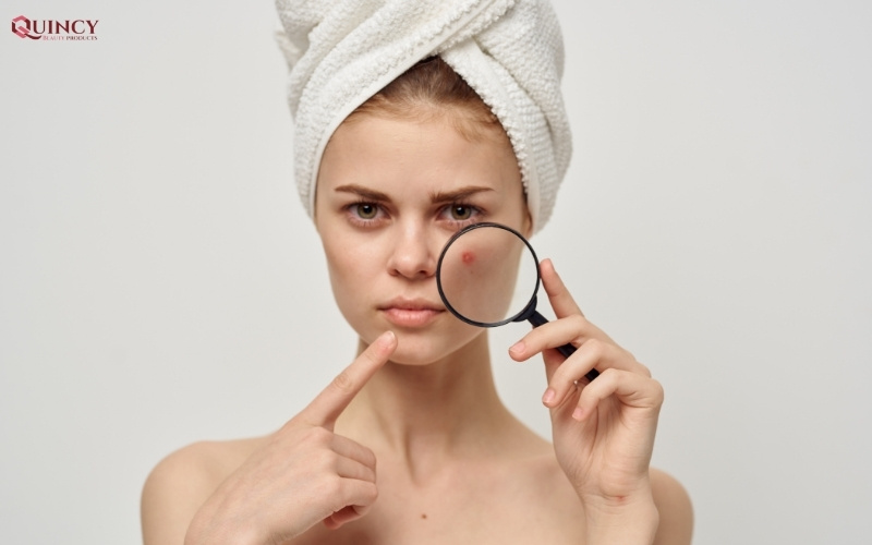 địa chỉ mua serum cho da mụn chính hãng giá tốt