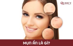 Mụn ẩn là gì?