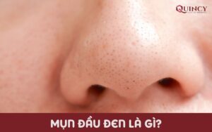 mụn đầu đen là gì?