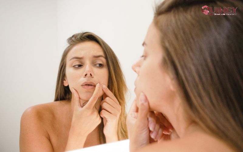 Mụn đầu đen là gì? Tìm hiểu phương pháp trị mụn hiệu quả nhất 11 Nguyên nhân gây mụn đầu đen