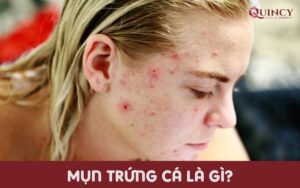 \Mụn trứng cá là gì?