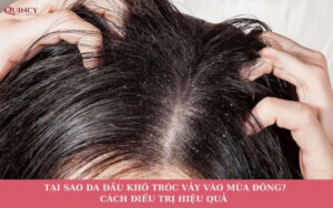 tại sao da đầu khô tróc vảy vào mùa đông