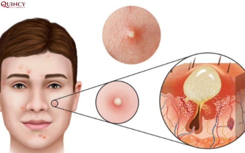 TOP serum điều trị mụn Hàn Quốc hiệu quả bạn nên biết 14 top serum điều trị mụn hàn quốc hiệu quả