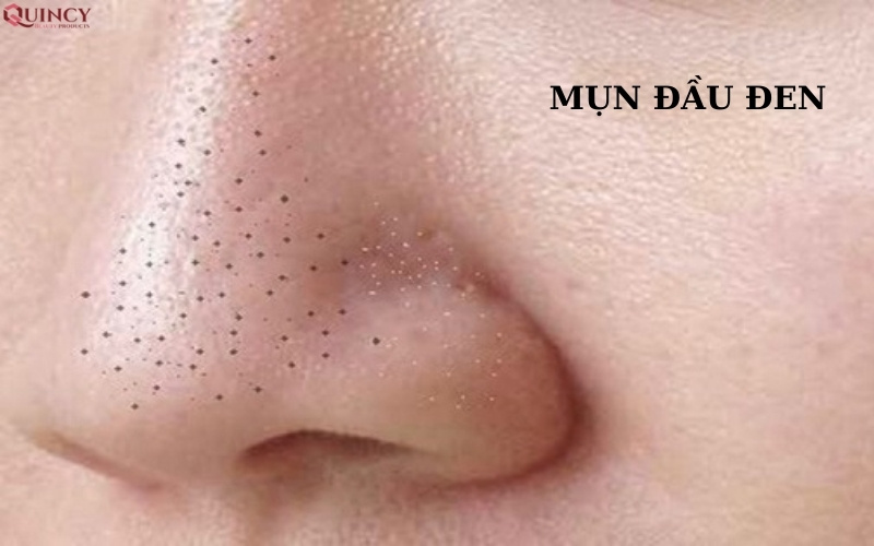 TOP serum điều trị mụn Hàn Quốc hiệu quả bạn nên biết 15 top serum điều trị mụn hàn quốc hiệu quả