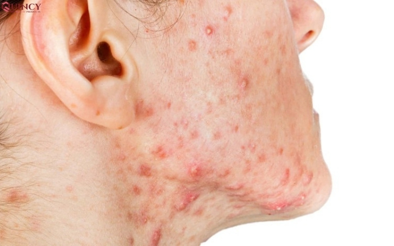 TOP serum điều trị mụn Hàn Quốc hiệu quả bạn nên biết 16 top serum điều trị mụn hàn quốc hiệu quả